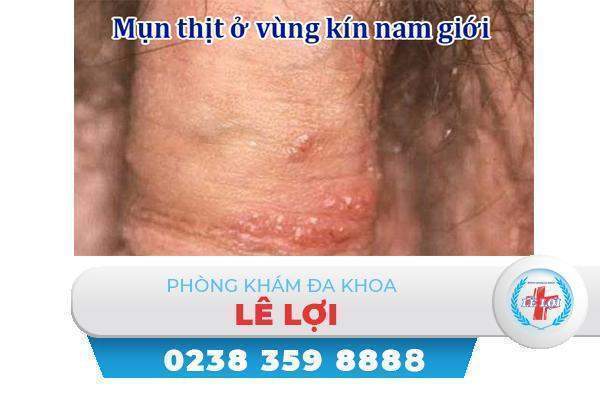 Mụn thịt dương vật có nguy hiểm không?