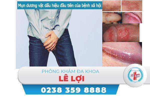 Mụn trắng quy đầu là dấu hiệu của bệnh xã hội