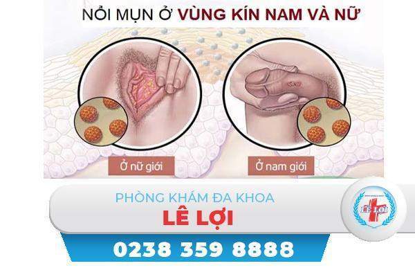 Vì sao vùng kín nổi mụn trắng?