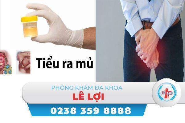 Tiểu có mủ là bị bệnh gì nguy hiểm không?