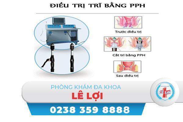 Cắt trĩ bằng phương pháp PPH hiệu quả không?