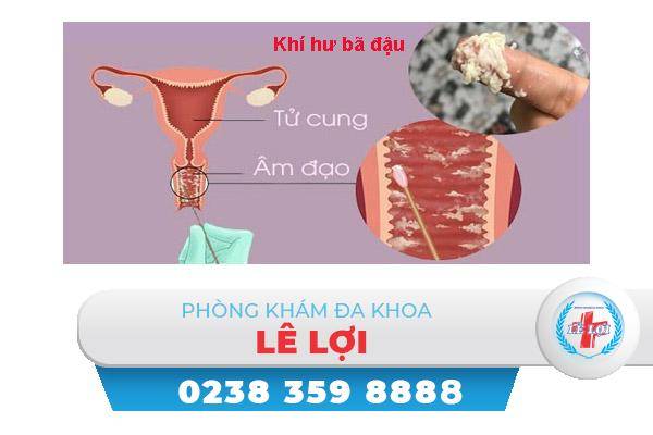 Khí hư bã đậu là bị bệnh gì?