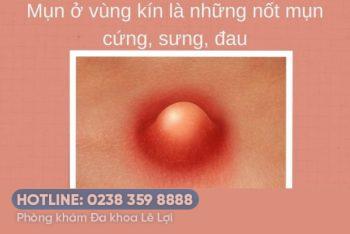 Nổi mụn trắng li ti vùng kín là bệnh gì?