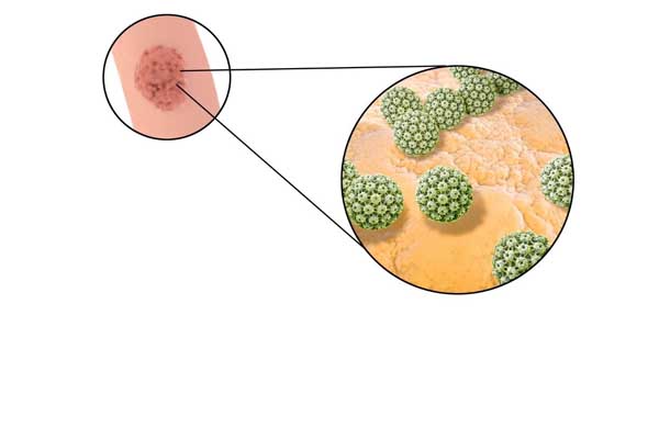 benh-condyloma-dau-hieu