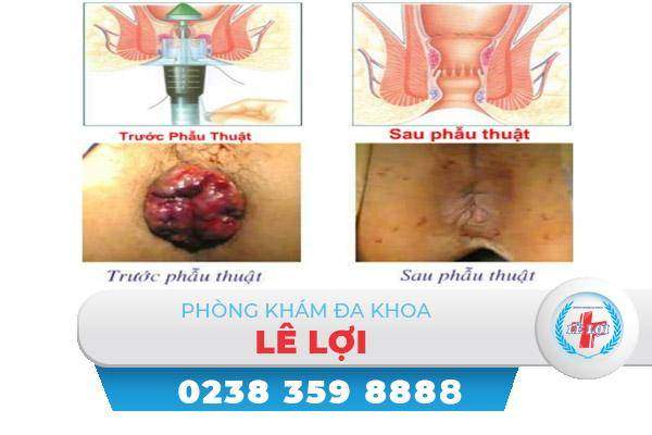 Phương pháp cắt trĩ Longo có tốt không?