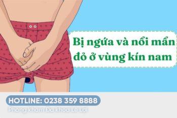 Dương vật nổi mẩn đỏ ngứa là bệnh gì?