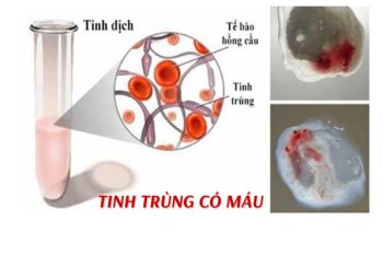 Nguyên nhân tinh trùng có máu và cách điều trị