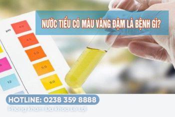 Nước tiểu màu vàng đậm là bị bệnh gì?