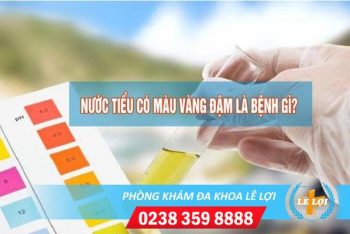 Nước tiểu màu vàng đậm là bị bệnh gì?