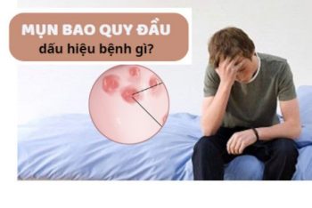 Mụn bao quy đầu có sao không cách điều trị thế nào?