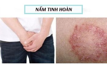 Nấm tinh hoàn nguyên nhân dấu hiệu và cách khắc phục