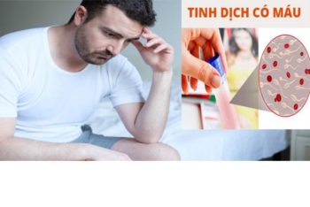 Tinh dịch có máu dấu hiệu cảnh báo bệnh lý nguy hiểm