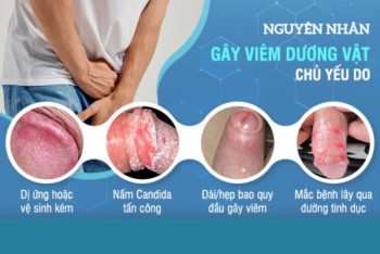 Dấu hiệu viêm dương vật ở nam và cách chữa trị