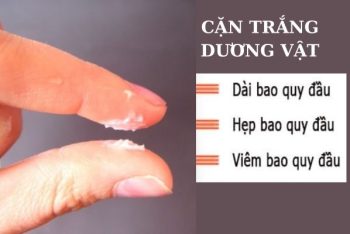 Cặn trắng dương vật dấu hiệu cảnh báo bệnh lý nguy hiểm