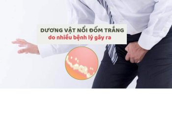 Dương vật nổi đốm trắng là bệnh gì?