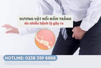 Dương vật nổi đốm trắng là bệnh gì?