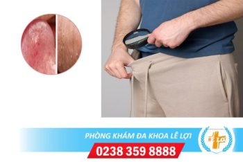 Nổi hột nổi hạt nhỏ ở bao quy đầu nguyên nhân và cách khắc phục