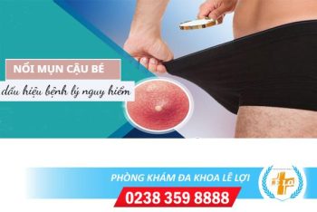 Nổi mụn cậu bé là bệnh gì?