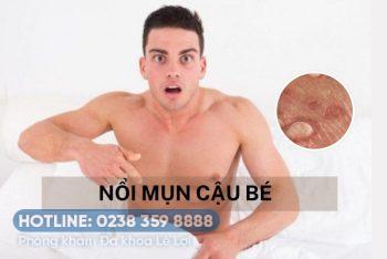 Nổi mụn cậu bé là bệnh gì?