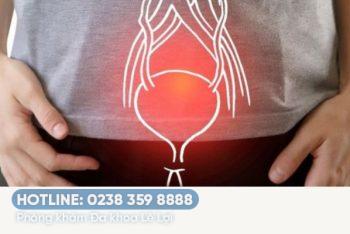 Đi tiểu nóng buốt là bị bệnh gì?