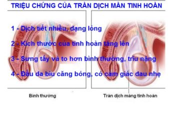 Dấu hiệu tràn dịch màn tinh hoàn và cách điều trị