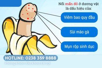 Dương vật nổi nốt ngứa, nổi hột ngứa là bị bệnh gì?