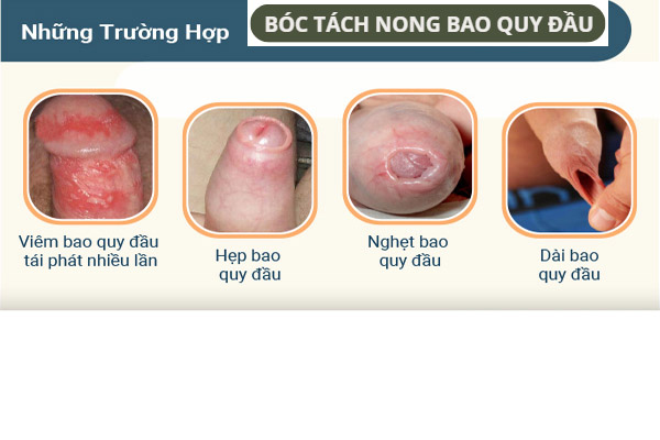 boc-tach-nong-bao-quy-dau