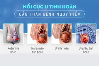 Cách điều trị u tinh hoàn hiệu quả