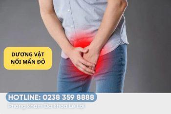 Đầu dương vật nổi mẩn đỏ là mắc bệnh lý gì?