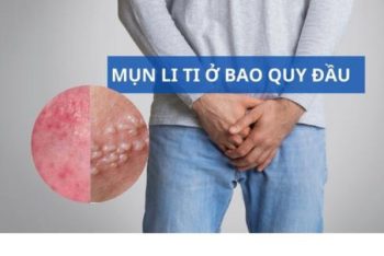 Mụn li ti ở bao quy đầu là bị bệnh gì nguy hiểm không?