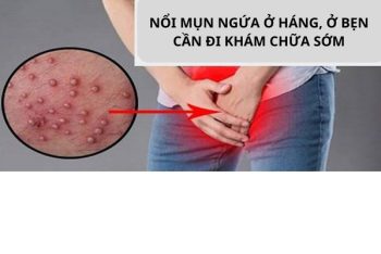 Phương pháp chữa nổi mụn ngứa ở háng, ở bẹn hiệu quả