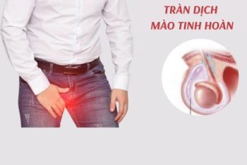 Tràn dịch mào tinh hoàn – nguyên nhân, dấu hiệu và cách chữa