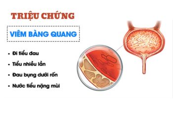 Cách chữa viêm bàng quang nam hiệu quả