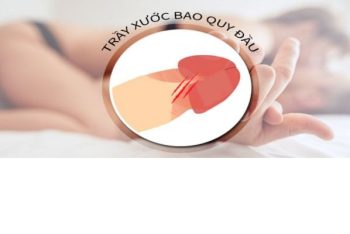 Bị xước bao quy đầu khi quan hệ nên làm gì?