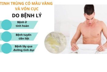 Tinh trùng có màu vàng và vón cục là bị bệnh gì?