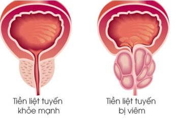 Viêm tuyến tiền liệt và những hiểm họa khôn lường